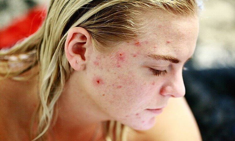 Woman-having-inflammed-acne-on-her-face